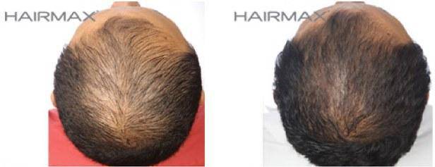 HairMax Before & After Results