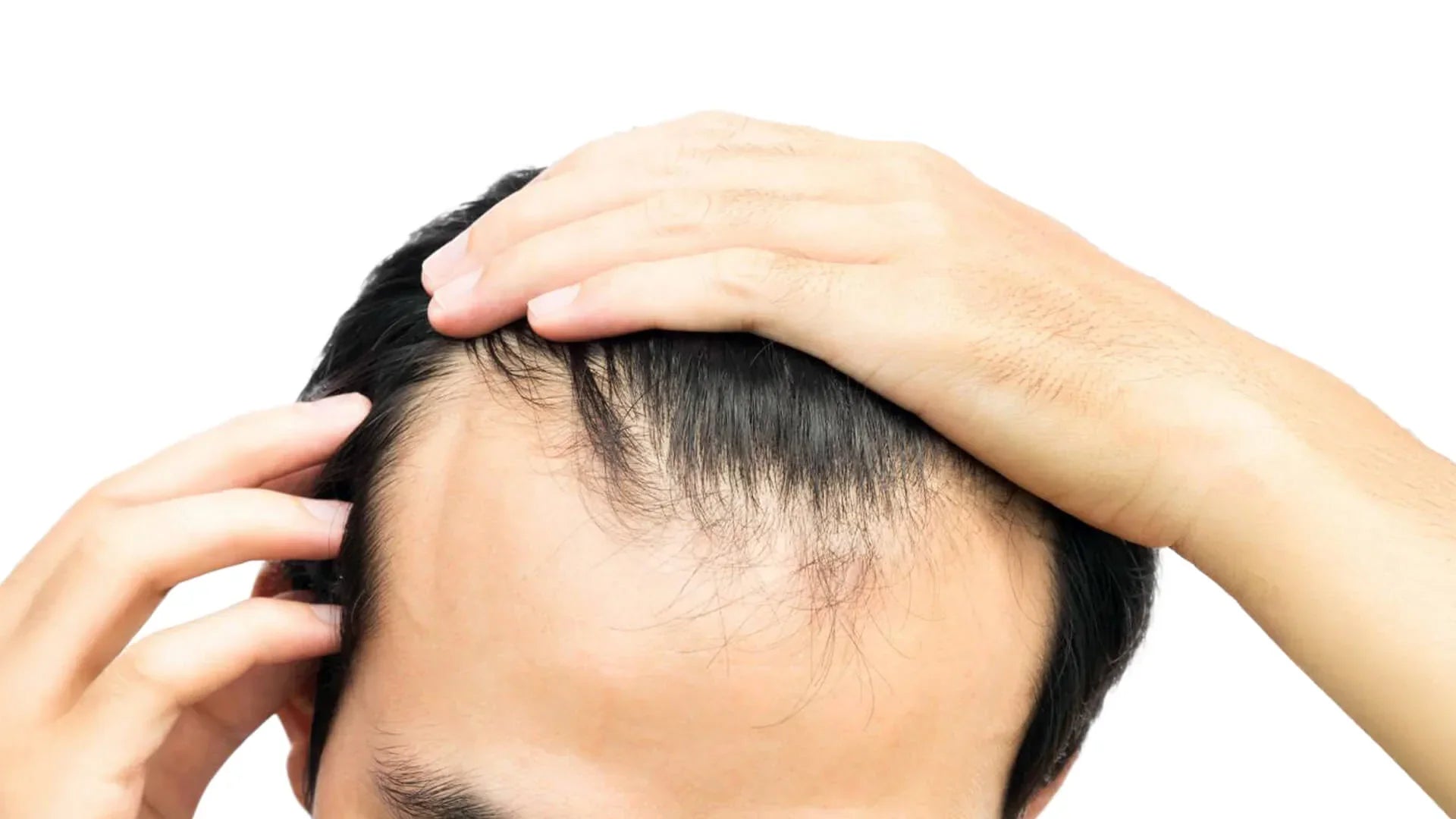 Hairline Starting to Thin? Causes and Ways to Support a Receding Hairline