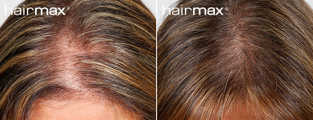 Hairmax® Ultima 9 Classic LaserComb – Hairmax Australia